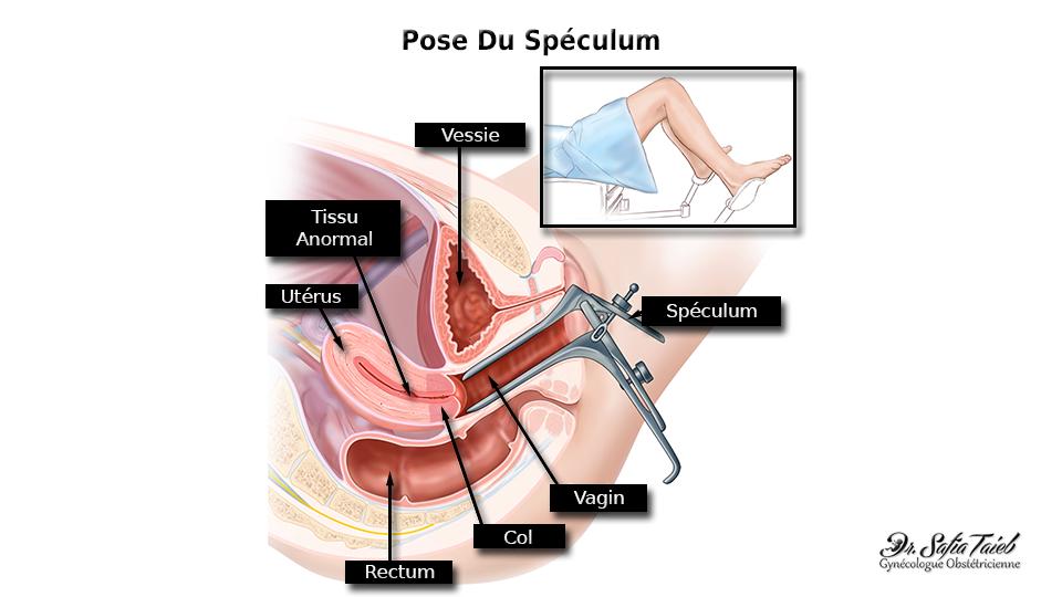 Curetage par aspiration