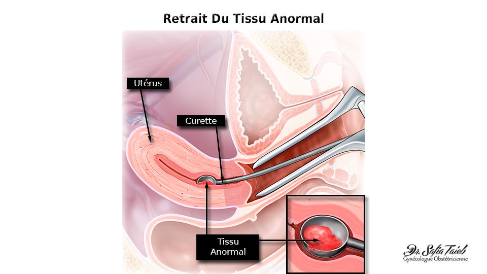 Curetage par aspiration