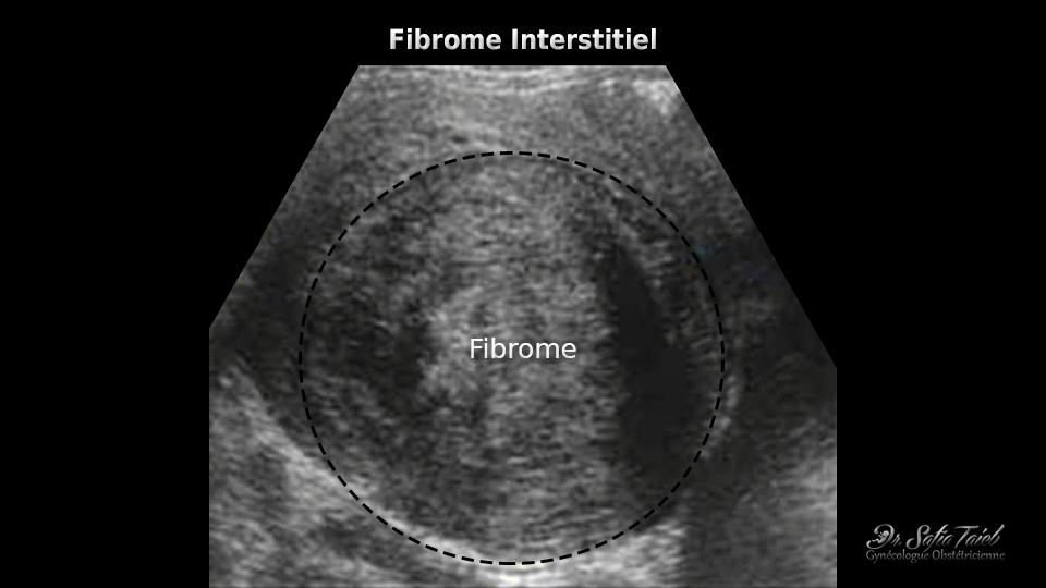 Fibrome Utérin