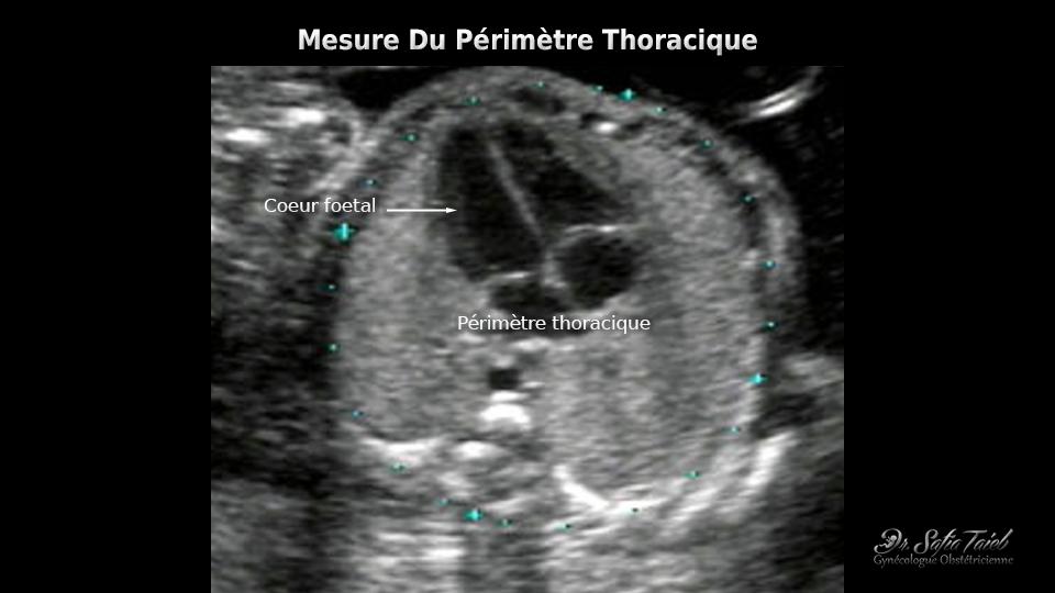 Echographie obstétricale de grossesse du TROISIEME TRIMESTRE chez la femme  enceinte sans ordonnance - Centre de santé du Marais