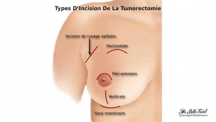 Types D'Incision De La Tumorectomie