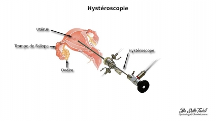 Hystéroscopie Hystéroscopie