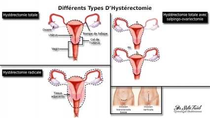 Différents Types D'Hystérectomie