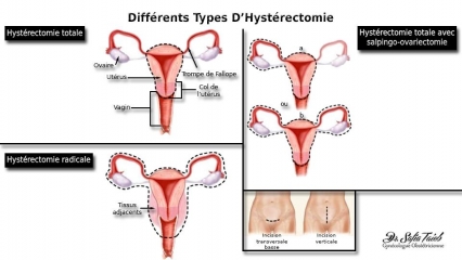 Différents Types D'Hystérectomie Différents Types D'Hystérectomie