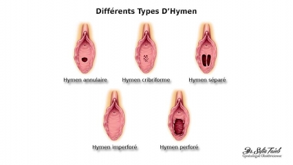 Différents Types D'Hymen Différents Types D'Hymen
