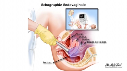 Echographie Endovaginale