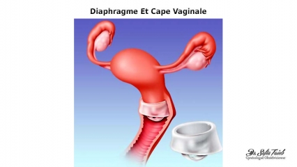 Diaphragme Et Cape Vaginale Diaphragme Et Cape Vaginale