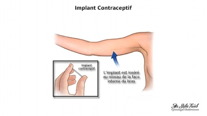Implant Contraceptif Implant Contraceptif