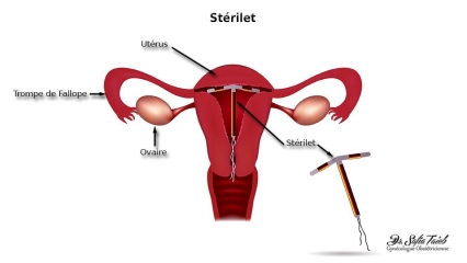 Stérilet Stérilet