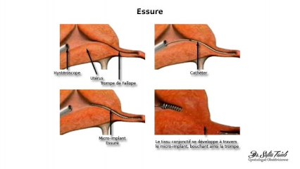 Essure Essure