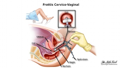 Frottis Cervico-Vaginal