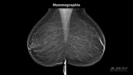 Mammographie Mammographie