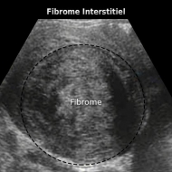 Différents types de fibromes