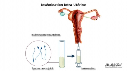 Insémination Intra-utérine Insémination Intra-utérine