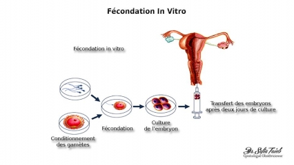 Fécondation In Vitro Fécondation In Vitro