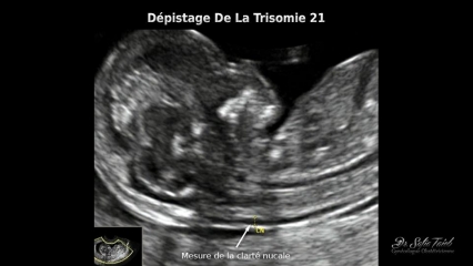 Dépistage De La Trisomie 21 Dépistage De La Trisomie 21