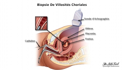 Biopsie De Villosités Choriales Biopsie De Villosités Choriales