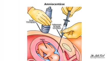 Amniocentèse Amniocentèse