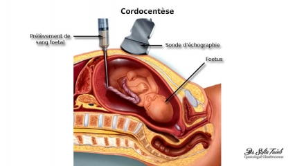 Cordocentèse Cordocentèse
