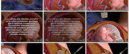 Biopsie De Villosites Choriales Technique Et Indications