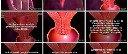 Interet Du Frottis Cervico Vaginal