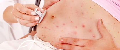 Varicelle Et Grossesse Varicelle Et Grossesse