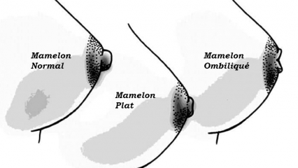 Différents types de mamelons Différents types de mamelons